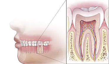 teeth-aligners