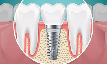 services-dental-implant